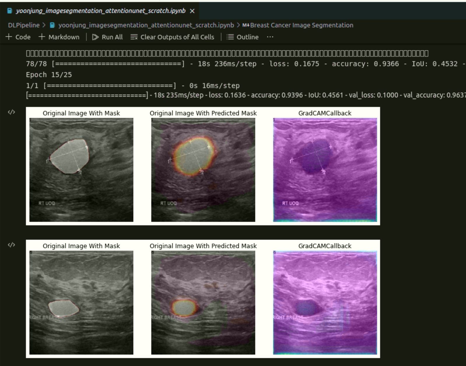 attention_unet_scratch_lesion_segmentation_learning_yoonjung.jpg