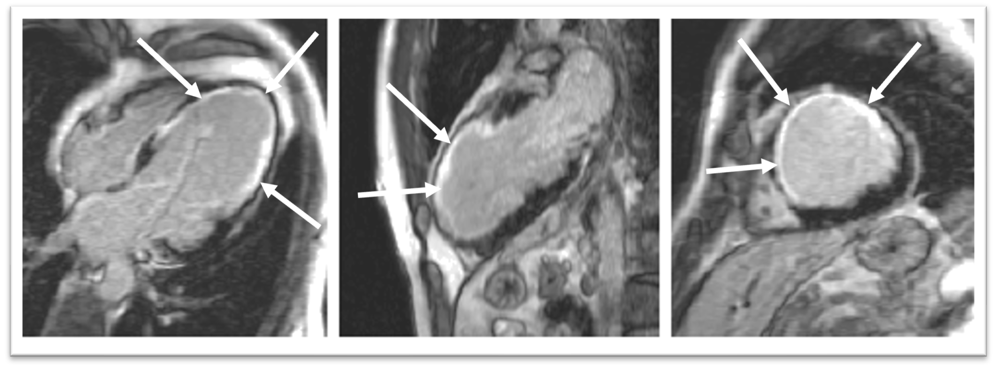 irm-cardiaque-infarctus-silencieux-medimage-2048x762.png