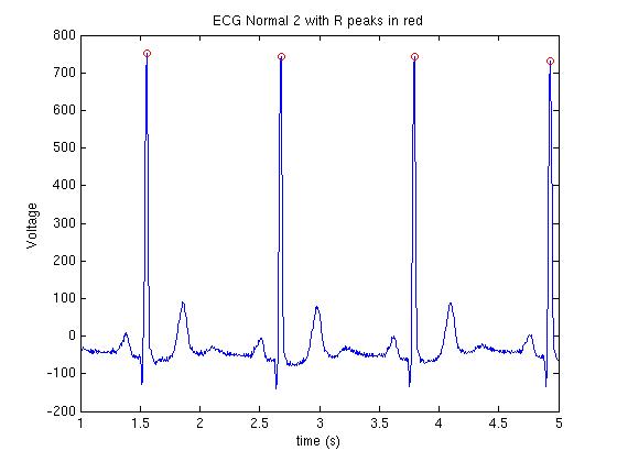 ECG2_local_max.jpg