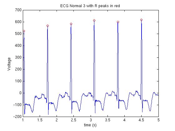 ECG3_local_max.jpg