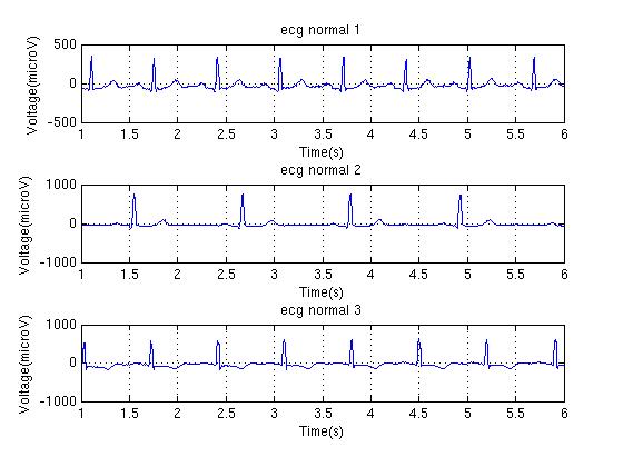 ecg_normal.jpg